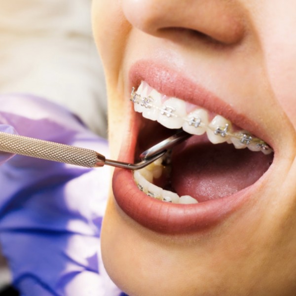 Ortodontik Tedavi (Diş Teli) 1